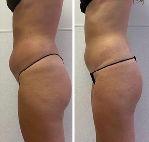 Weight loss package EMS 1 area