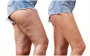 Cellulite and Stretch mark