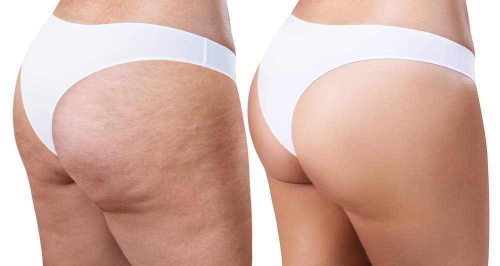 Cellulite and Stretch mark
