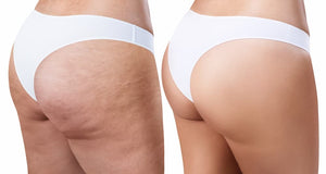 Cellulite and Stretch mark
