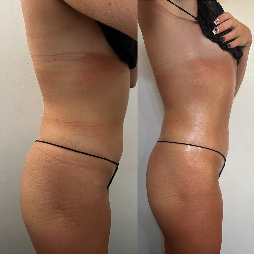 Weight loss package EMS 1 area