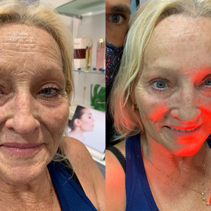 Sozan m. - age 65 LED TREATMENT