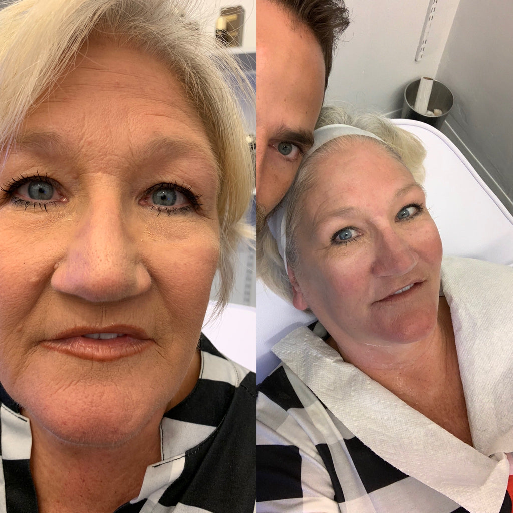 Eliyana age 54 led treatment