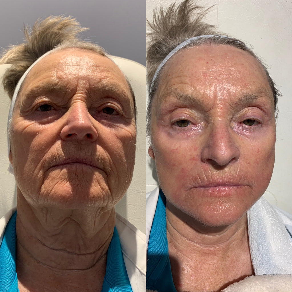 Anne 70+ amazing results