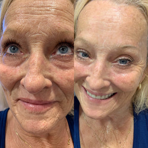 Sozan m. - age 65 LED TREATMENT